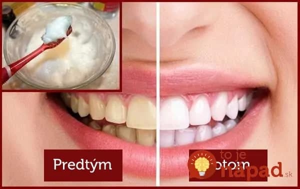 5 jednoduchých spôsobov, ako odstrániť zubný povlak a získať žiarivý úsmev