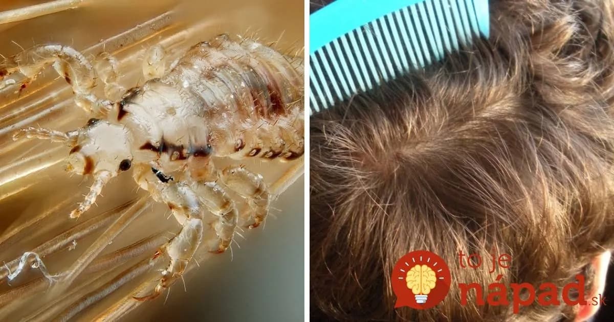 Prinieslo vaše dieťa zo školy vši a prostriedok z lekárne nezaberá? TOTO musíte urobiť, aby sa nerozšírili!