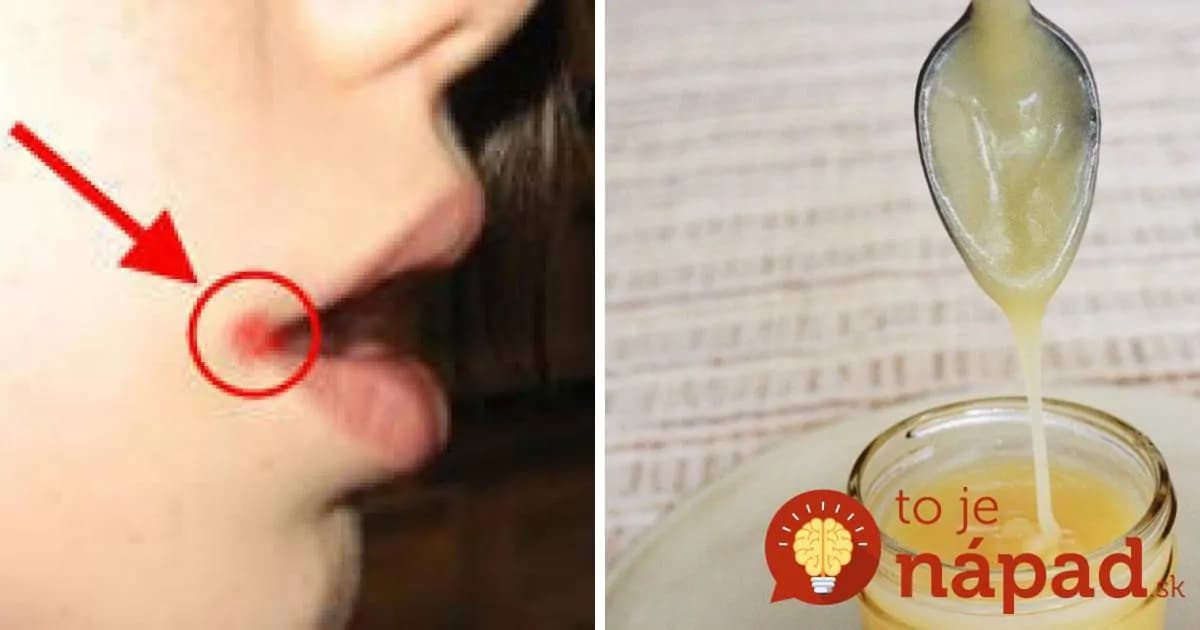 Trápia vás bolestivé popraskané kútiky na perách? Toto pomôže okamžite!