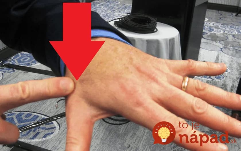 Pinzetu ani neberte do rúk, toto funguje perfektne: 100 rokov starý trik, ako bezbolestne vybrať zapichnutú triesku za pár sekúnd!