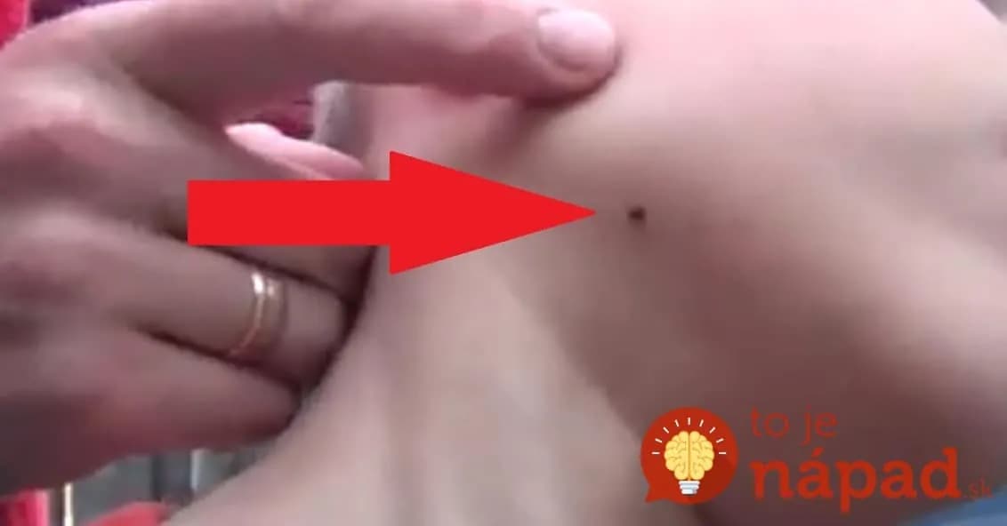 Nepotrebujete pinzetu: Otecko ukázal, ako sa zbaviť nenávideného kliešťa za pár sekúnd!