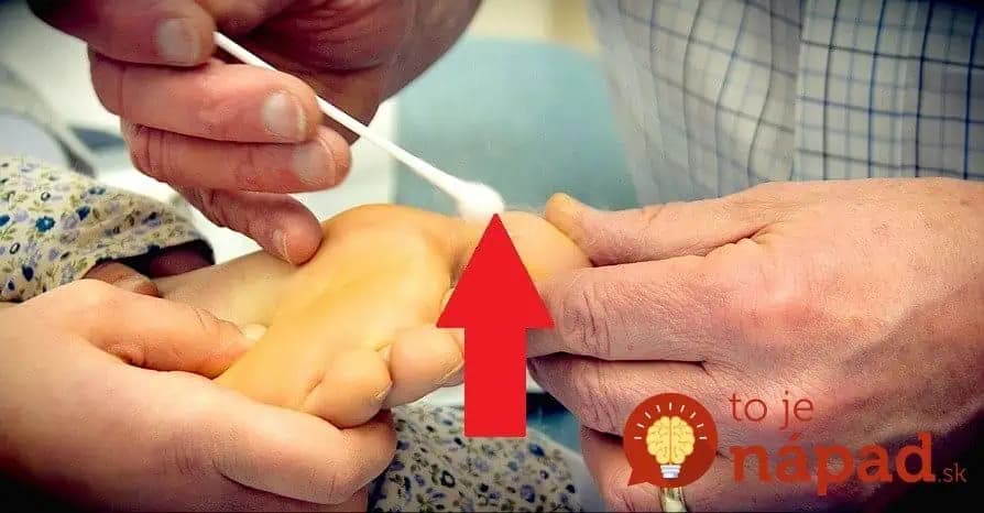 Najlepšia rada ako na bradavice a kurie oká BEZ vypaľovania: Toto mi poradila mama, bradavica ZMIZLA po pár dňoch!