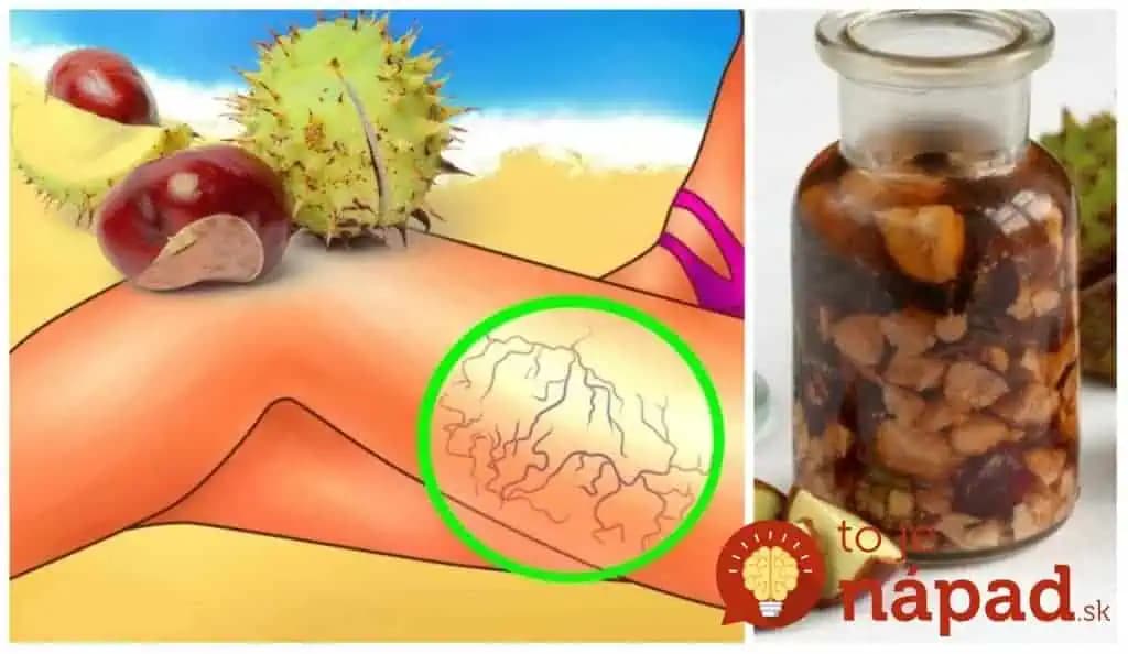 Keď skúsite, čo dokážu obyčajné gaštany s boľavým kolenom a kŕčovými žilami, budete si ich všímať omnoho viac: Stačia 2 hrste!
