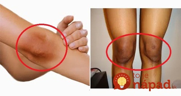 Ako odstrániť nepekné tmavé škvrny na prstoch, lakťoch a kolenách?